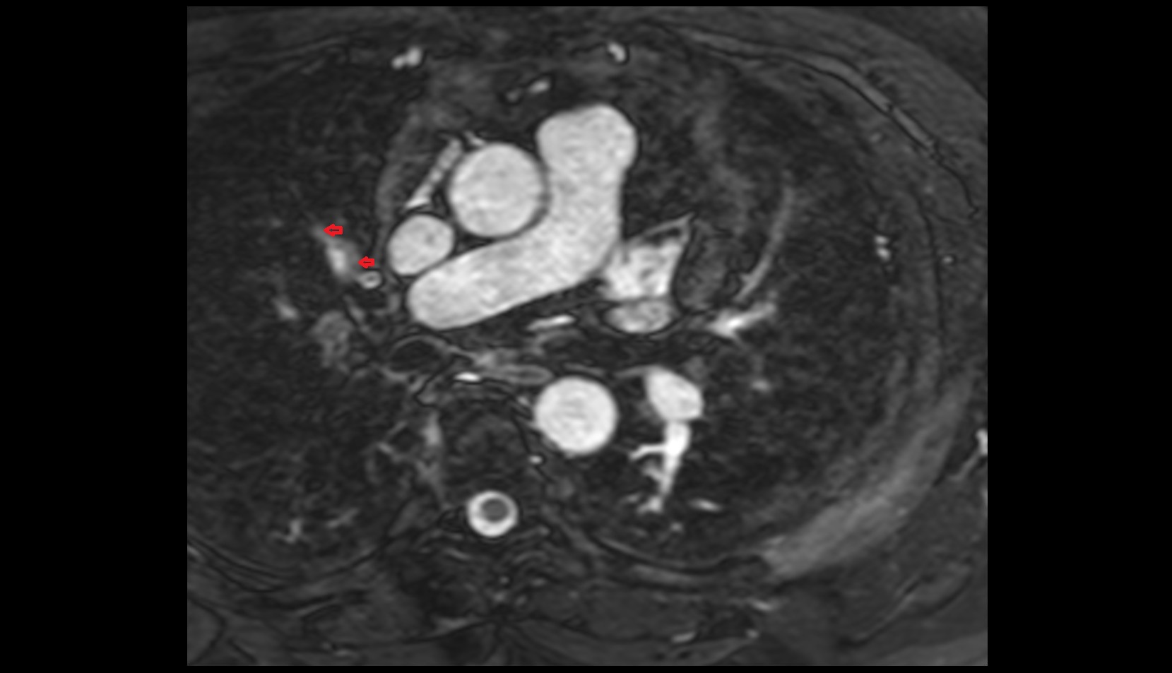 Anterior vein of right lung MRI IMAGE