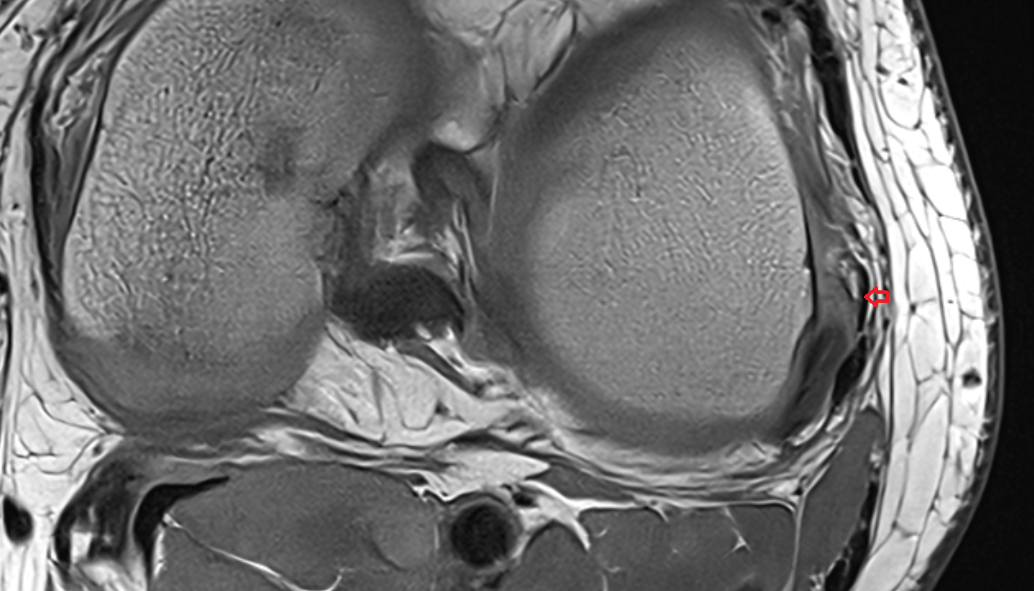 Anterolateral Ligament of Knee (ALL) axial cross sectional anatomy 3T MRI AI enhanced  radiology  anatomy image-img-00000-00000
