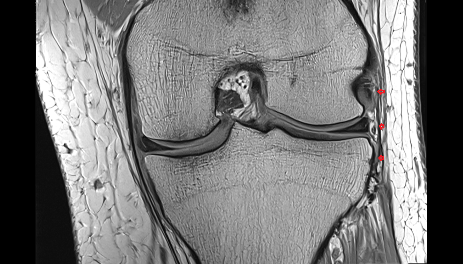 Anterolateral Ligament of Knee (ALL)  coronal cross sectional anatomy 3T MRI AI enhanced  radiology  anatomy image-img-00000-00000