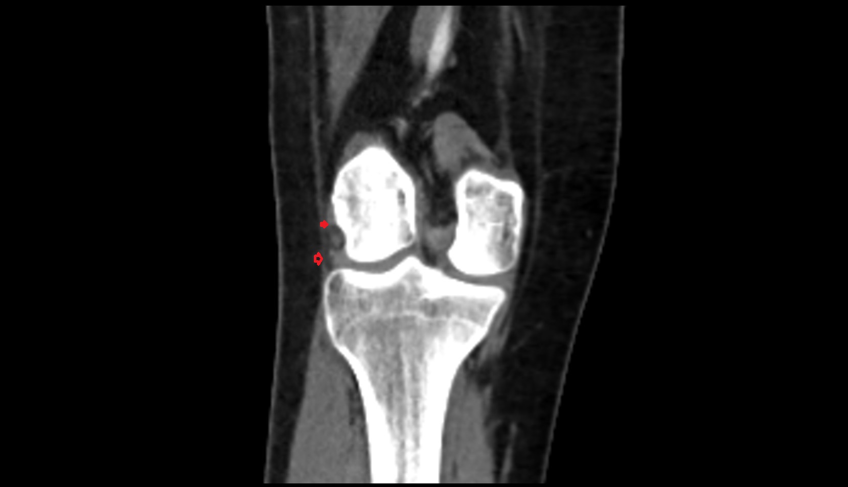 Anterolateral Ligament of Knee (ALL) coronal ct image