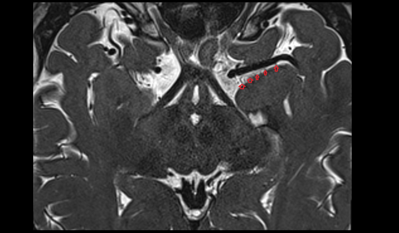 Anterolateral central (lenticulostriate) arteries MRI 3T axial image