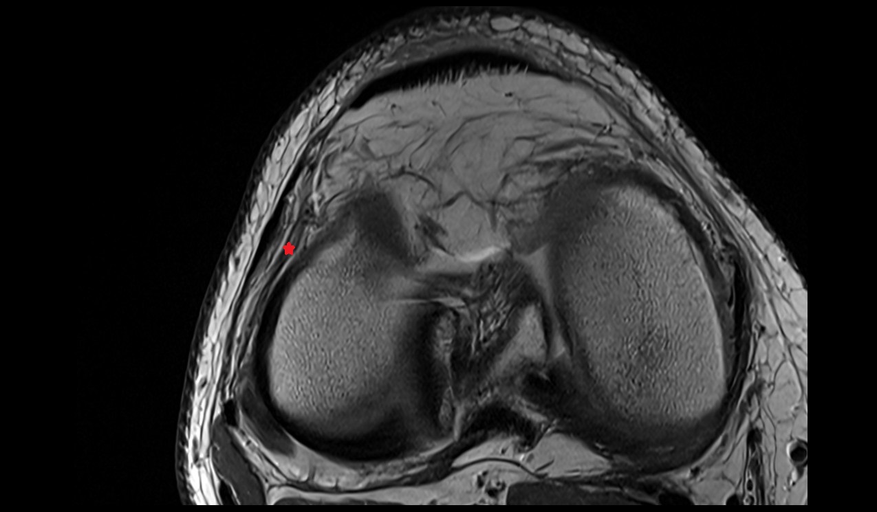 Anterolateral ligament anatomy image