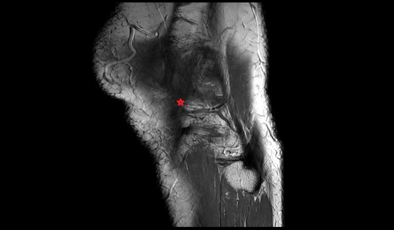 Anterolateral ligament anatomy image  radiology mri anatomy image
