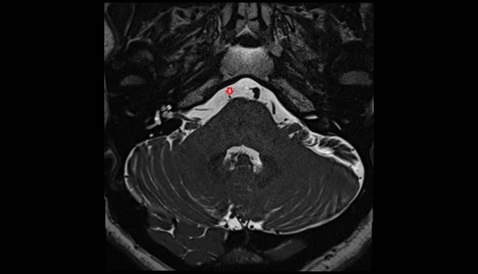 Anterolateral medullary vein MRI 3T axial image