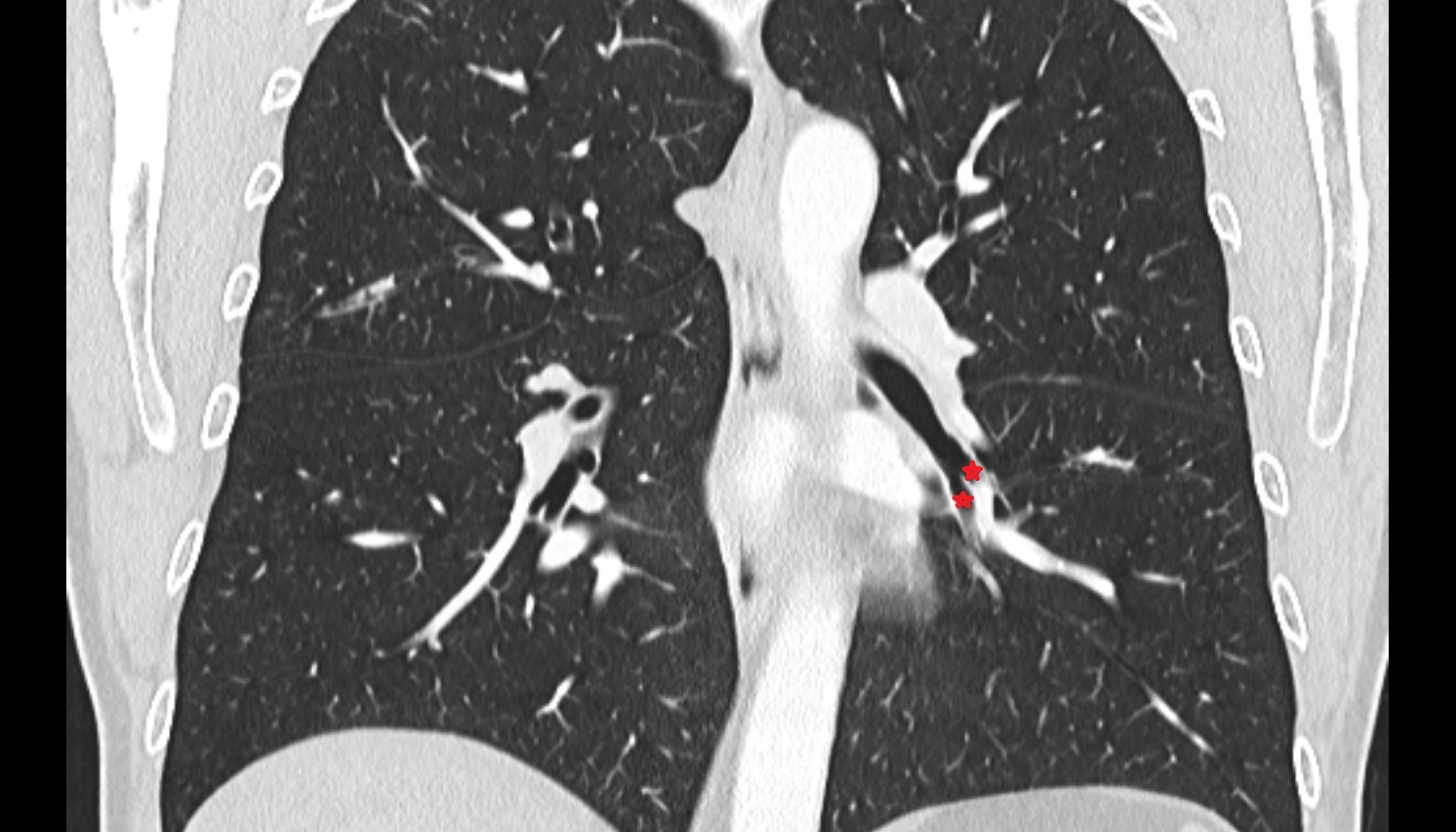 Anteromedial basal bronchus of left lung (B7+8) anatomy  CT coronal  image -img-00000-00000