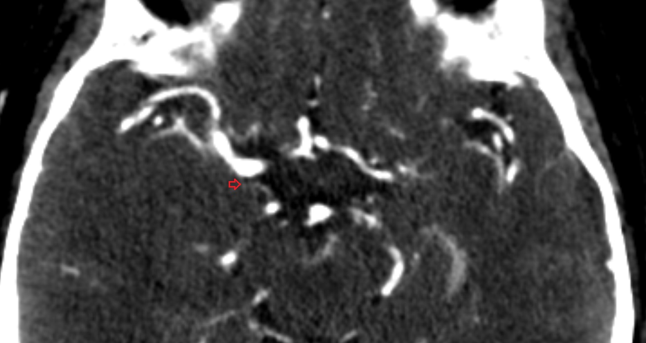 Anteromedial central (perforating) arteries anatomy CT axial anatomy image -img-00001-00001