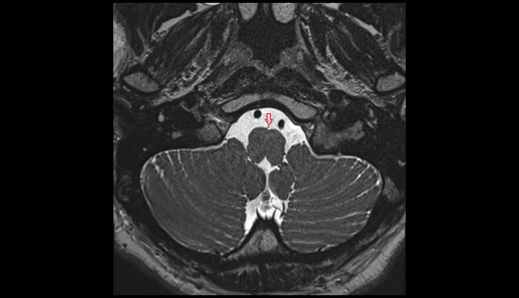 Anteromedian medullary vein mri 3t axial image