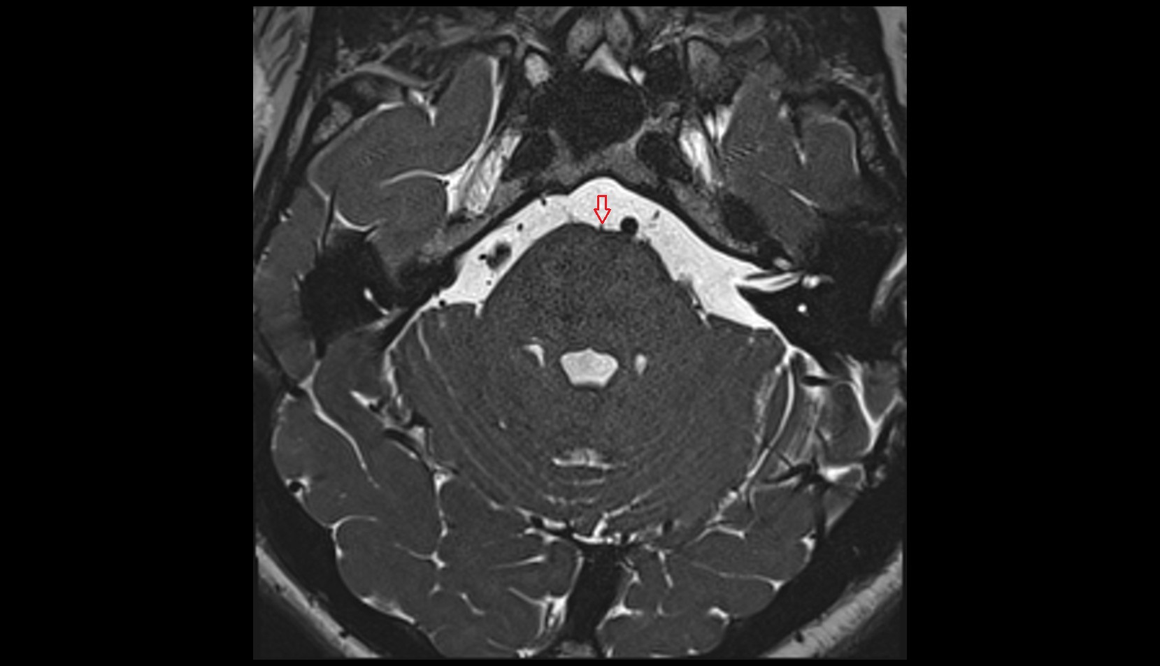 Anteromedian pontine vein MRI 3T axial image