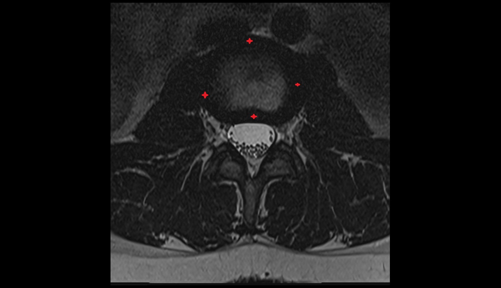 Anulus fibrosus, Intervertebral disc mri axial image