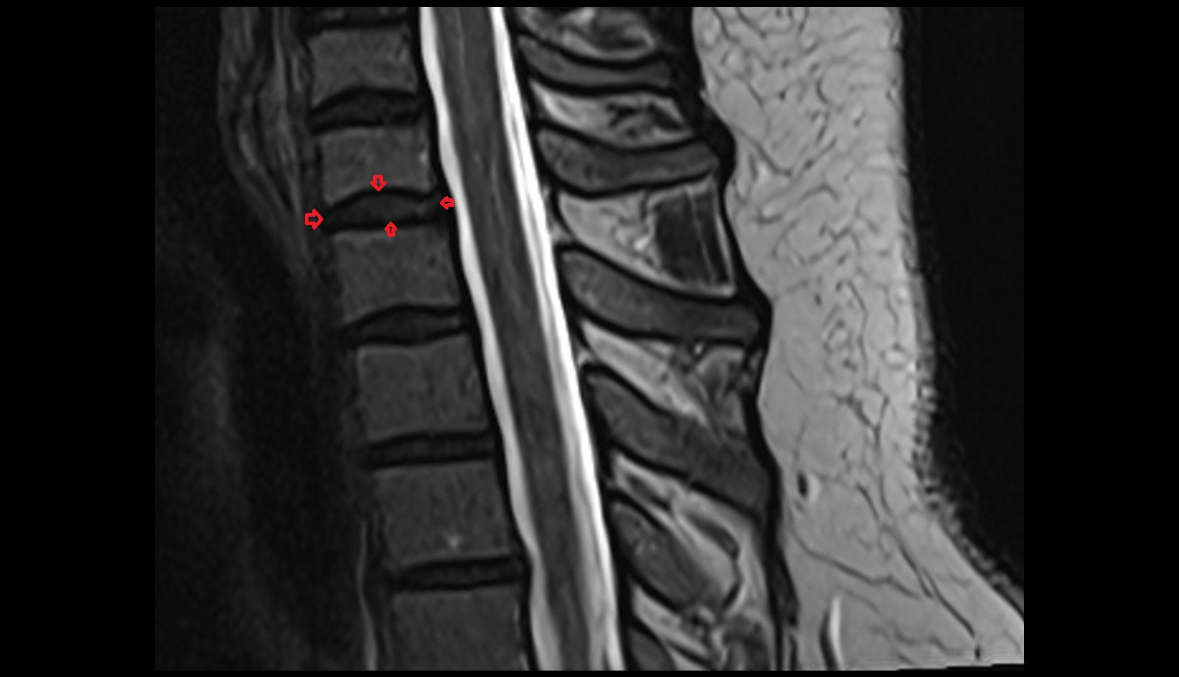 Anulus fibrosus, Intervertebral disc mri sagittal image