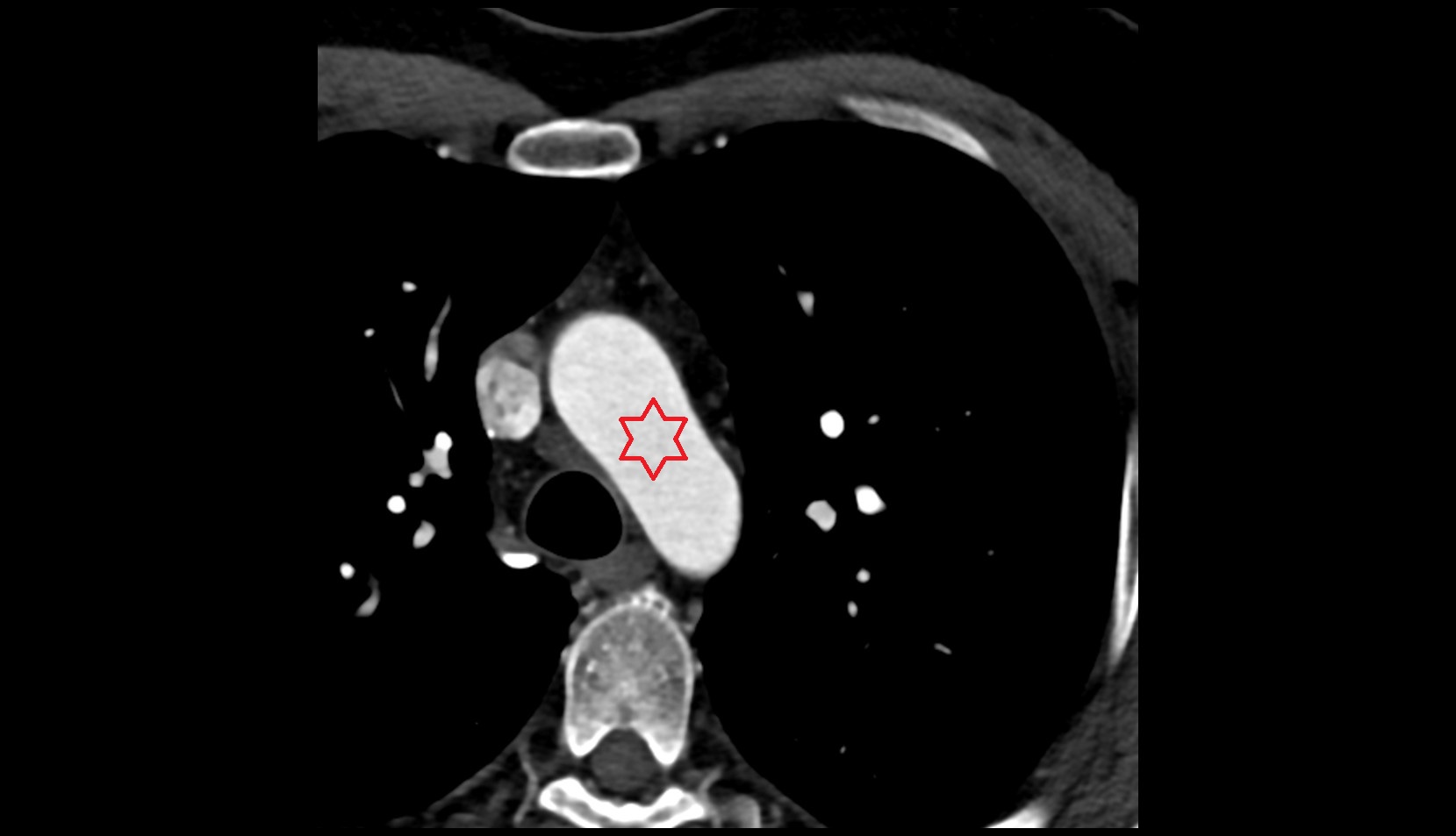 Aortic arch CT AXIAL IMAGE