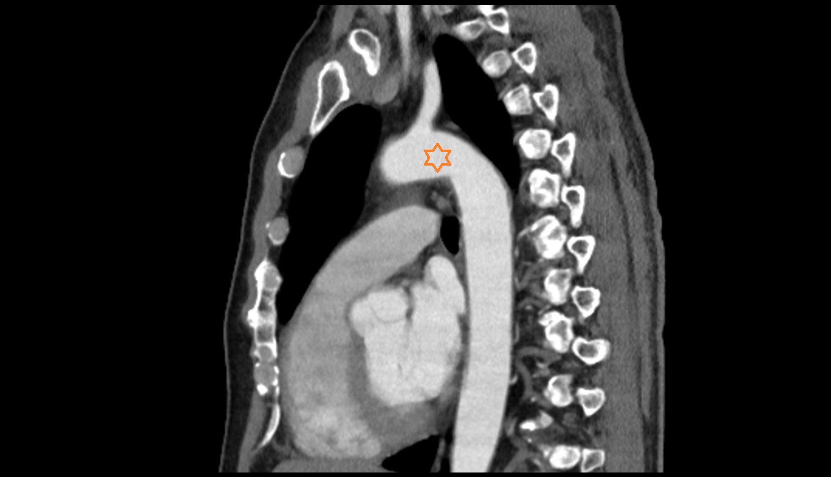 Aortic arch CT SAG
