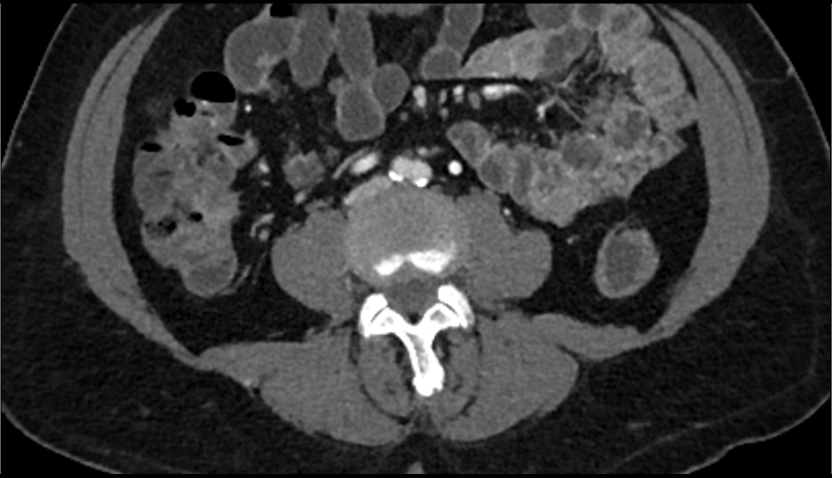 Aortic bifurcation CT axial image