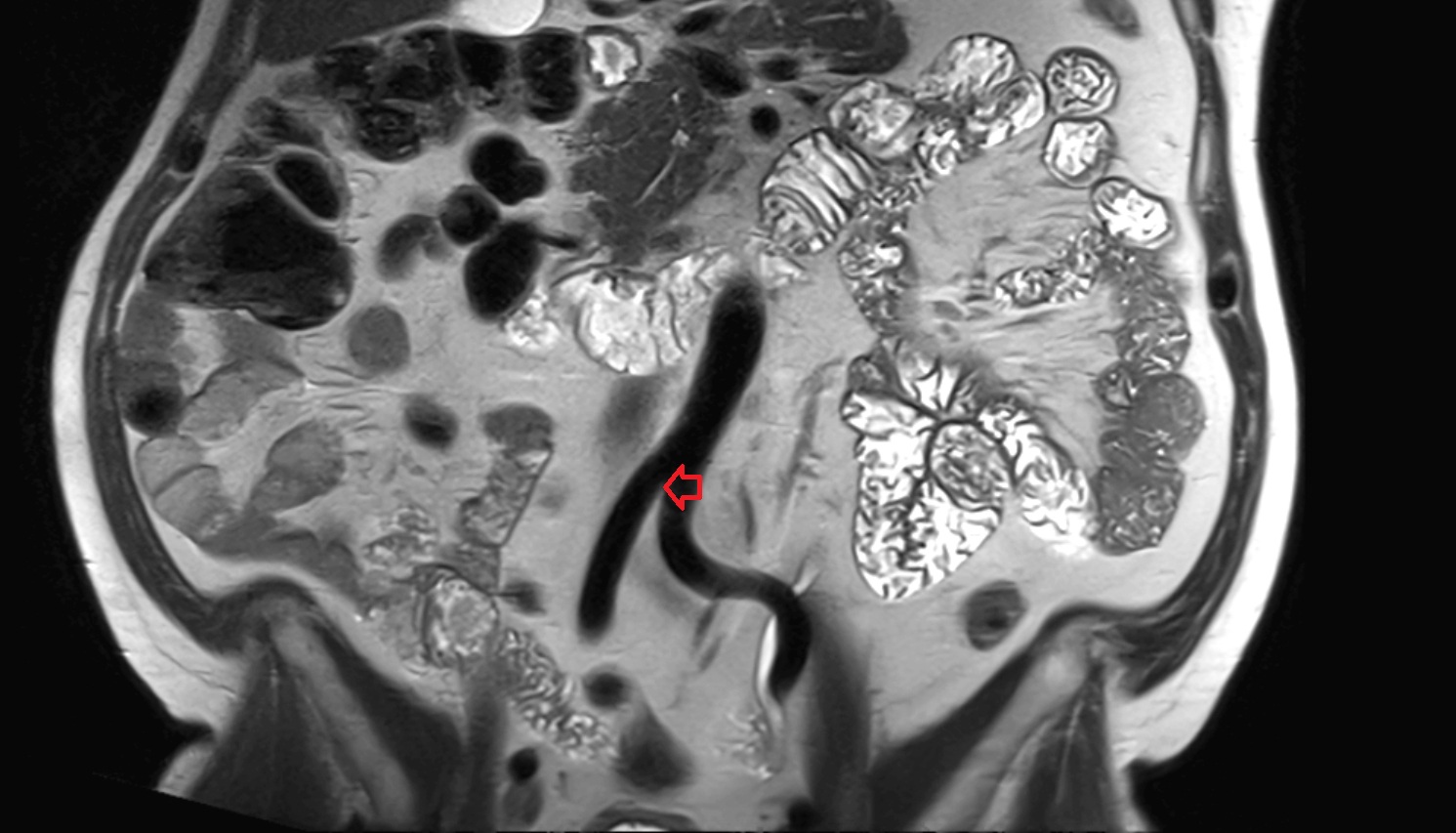 Aortic bifurcation  MRI coronal anatomy  image -img-00000-00000