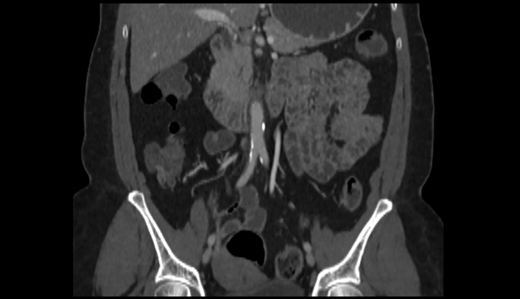 Aortic bifurcation ct CORONAL IMAGE