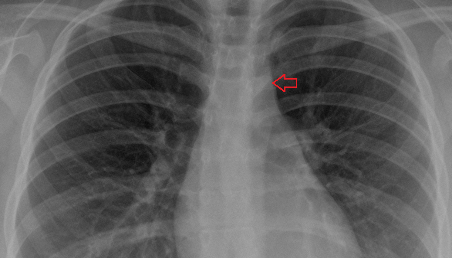 Aortic knob Anatomy, Location and Imaging Appearance CT anatomy image -img-00000-00000