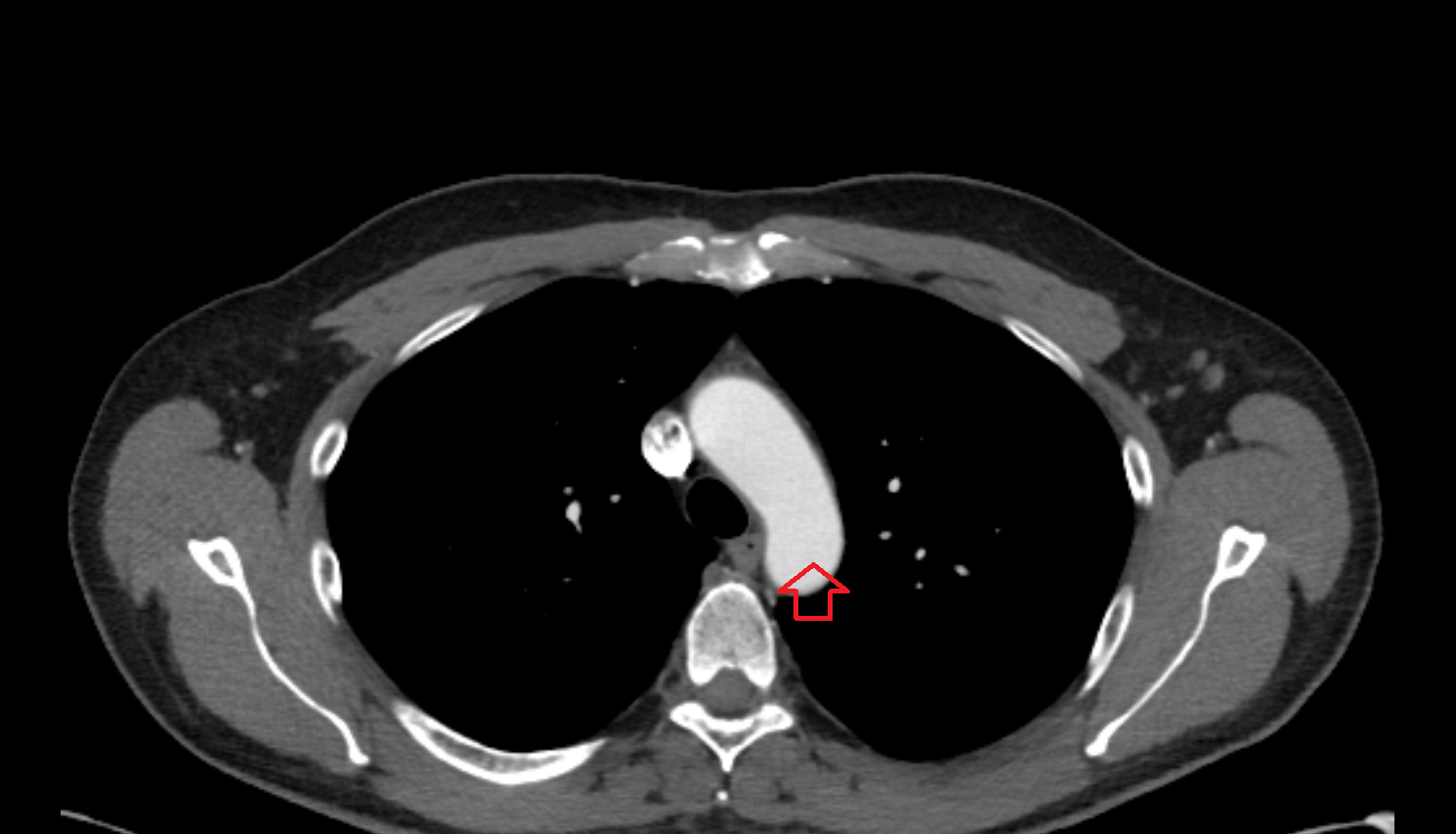 Aortic knob Anatomy, Location and Imaging Appearance CT anatomy image -img-00000-00000_00001