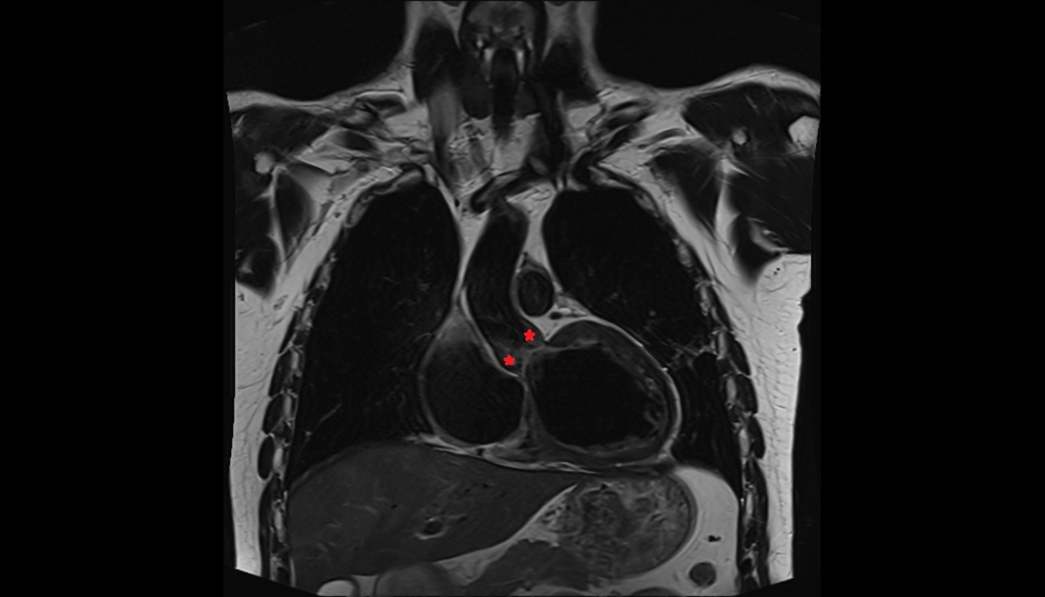 Aortic sinus  anatomy MRI coronal  image -img-00000-00000