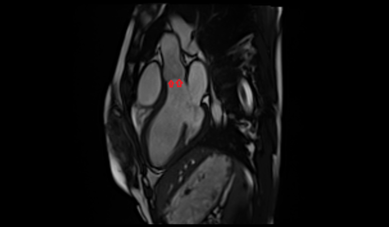 Aortic valve MRI image