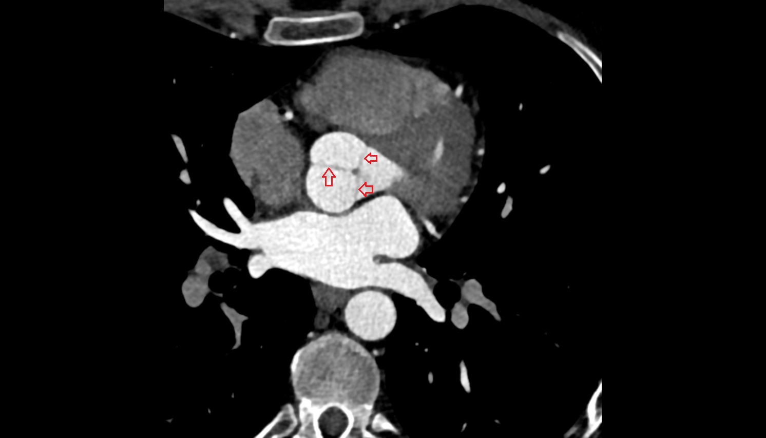 Aortic valve anatomy CT axial   image -img-00000-00000_00001