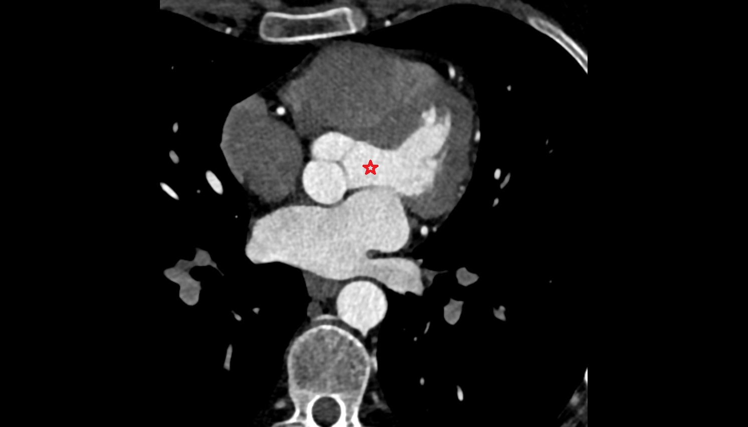Aortic vestibule anatomy  CT axial   image -img-00000-00000