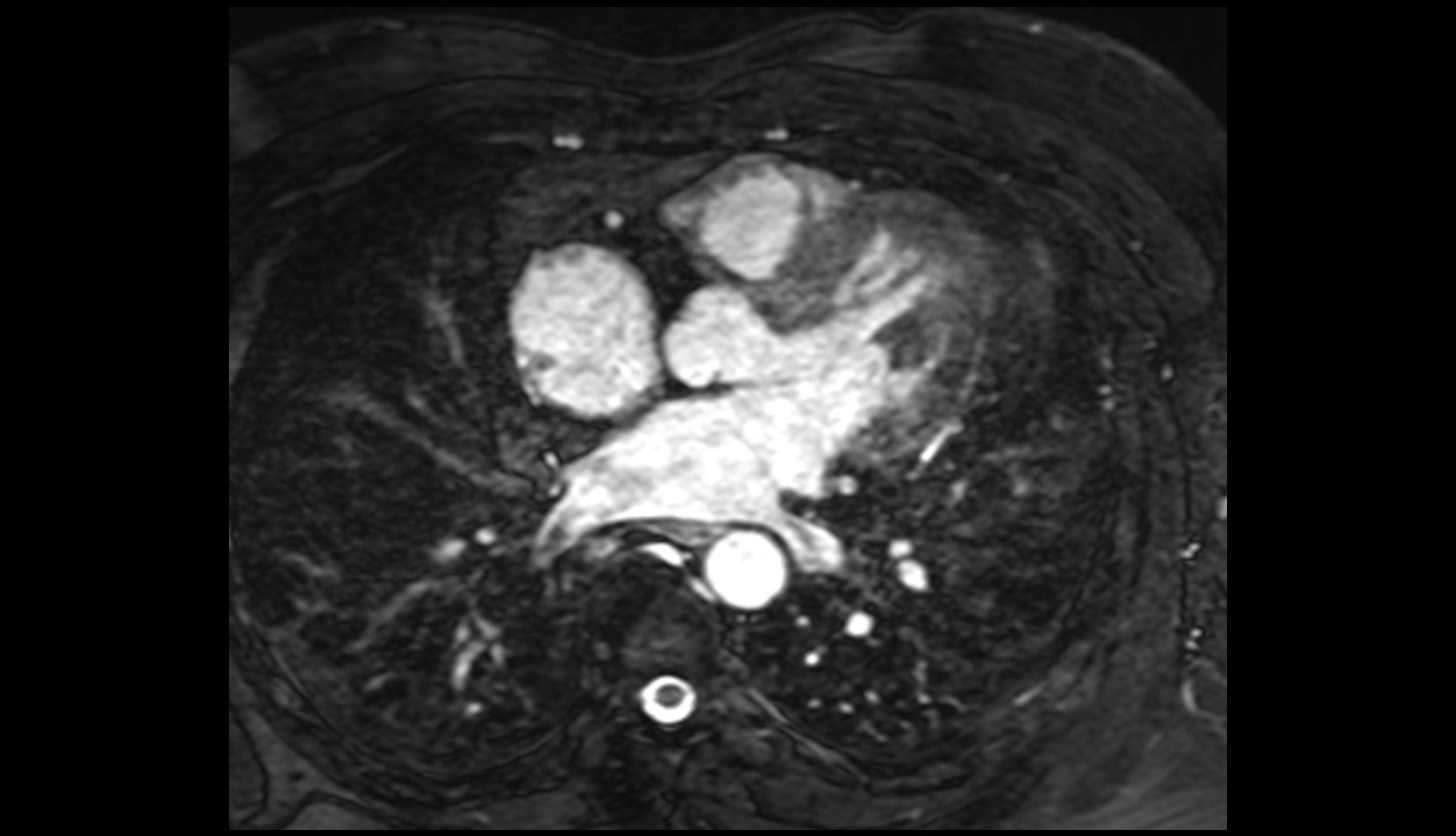 Aortic vestibule mri image