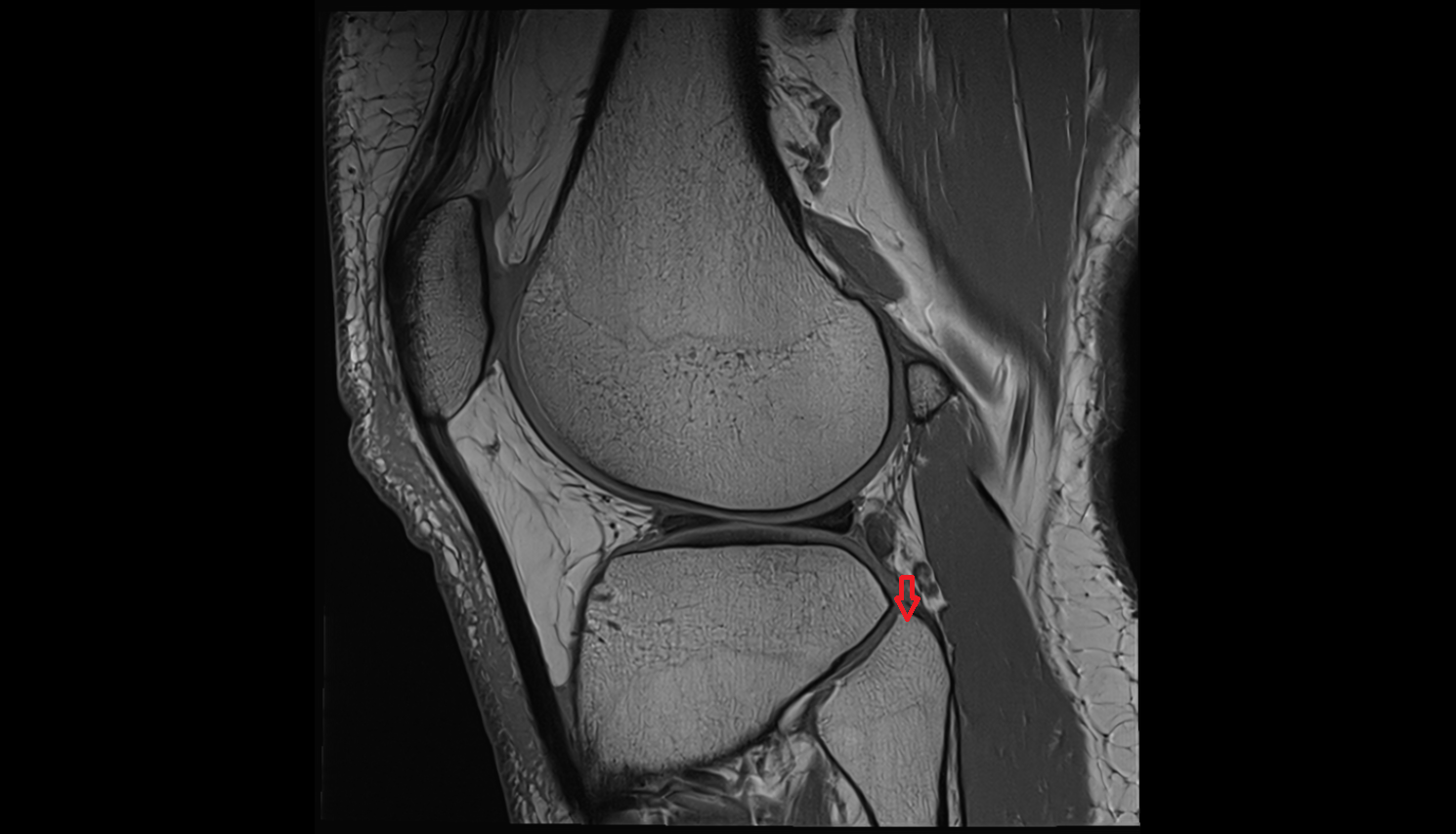 Apex of head of fibula  mri  anatomy labelled image-img-00000-00000
