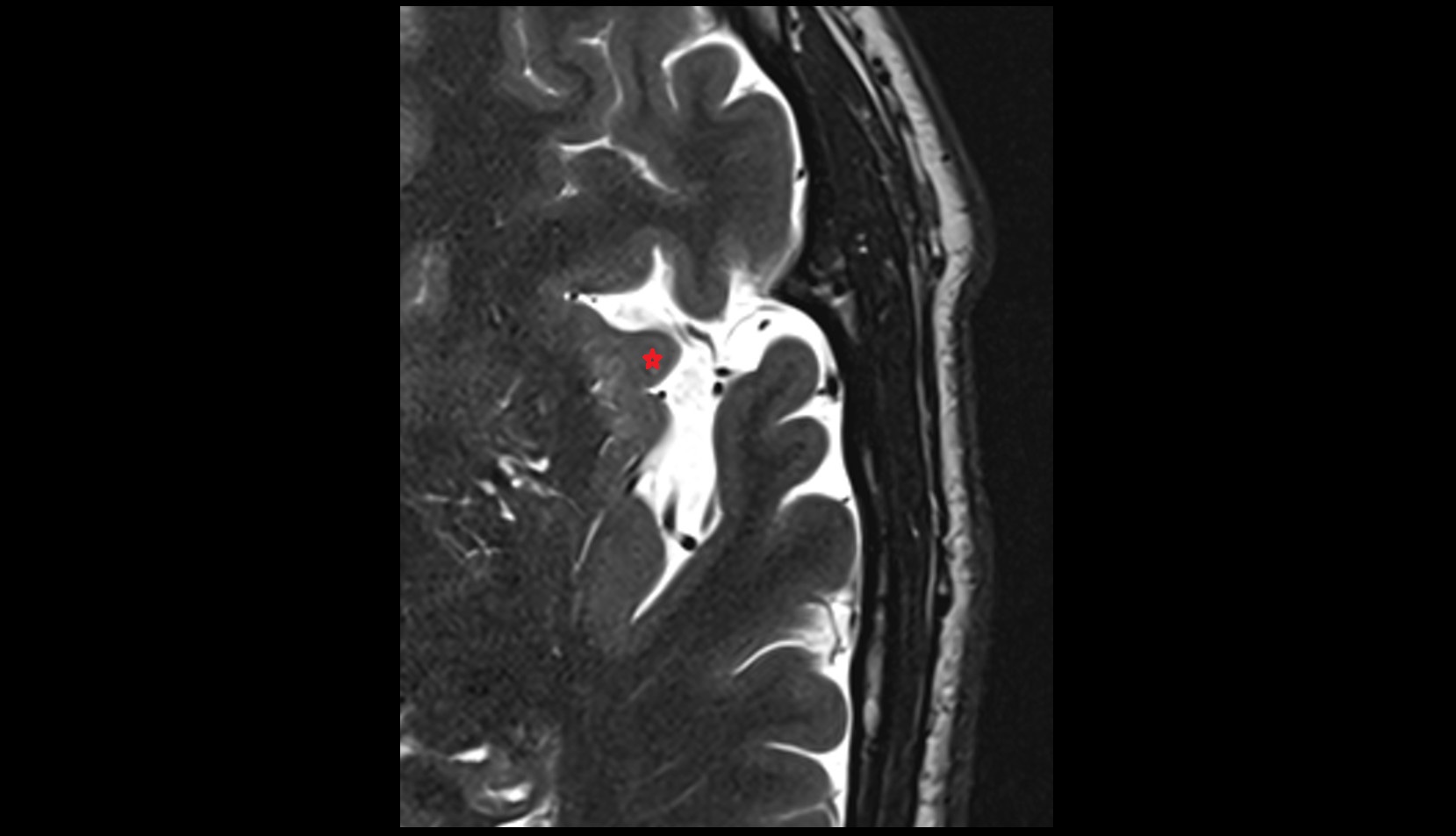 Apex of insula MRI axial image