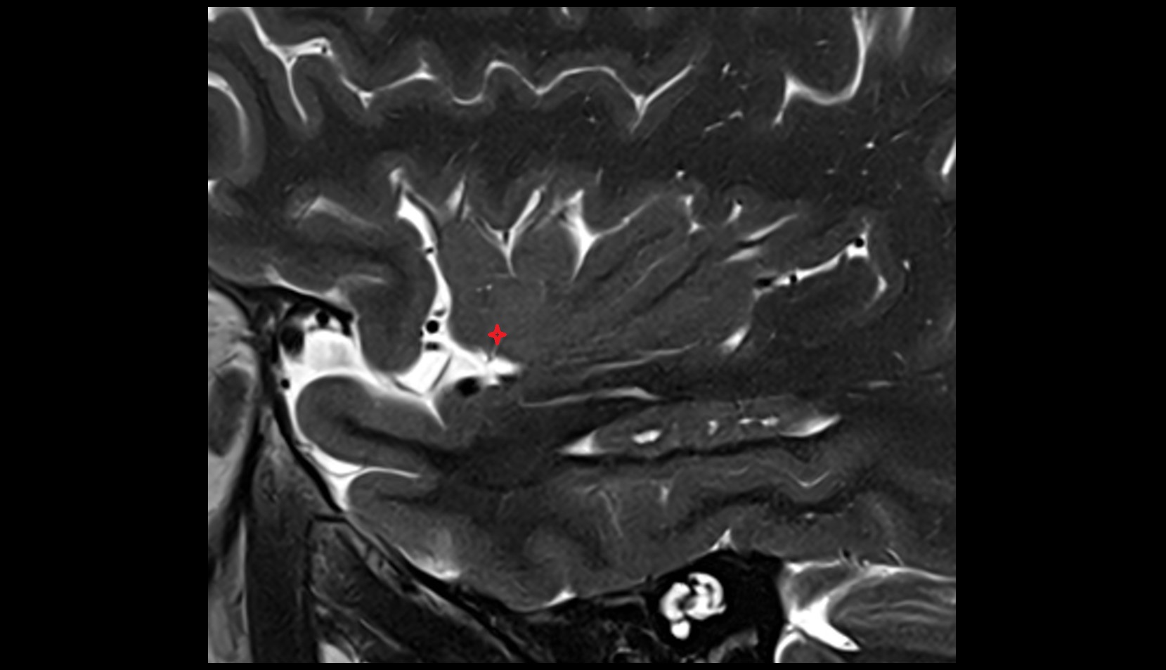 Apex of insula sag mri image