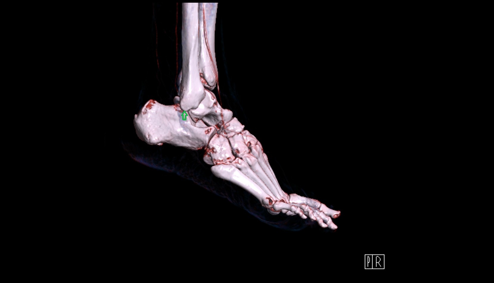 Apex of lateral malleolus 3d
