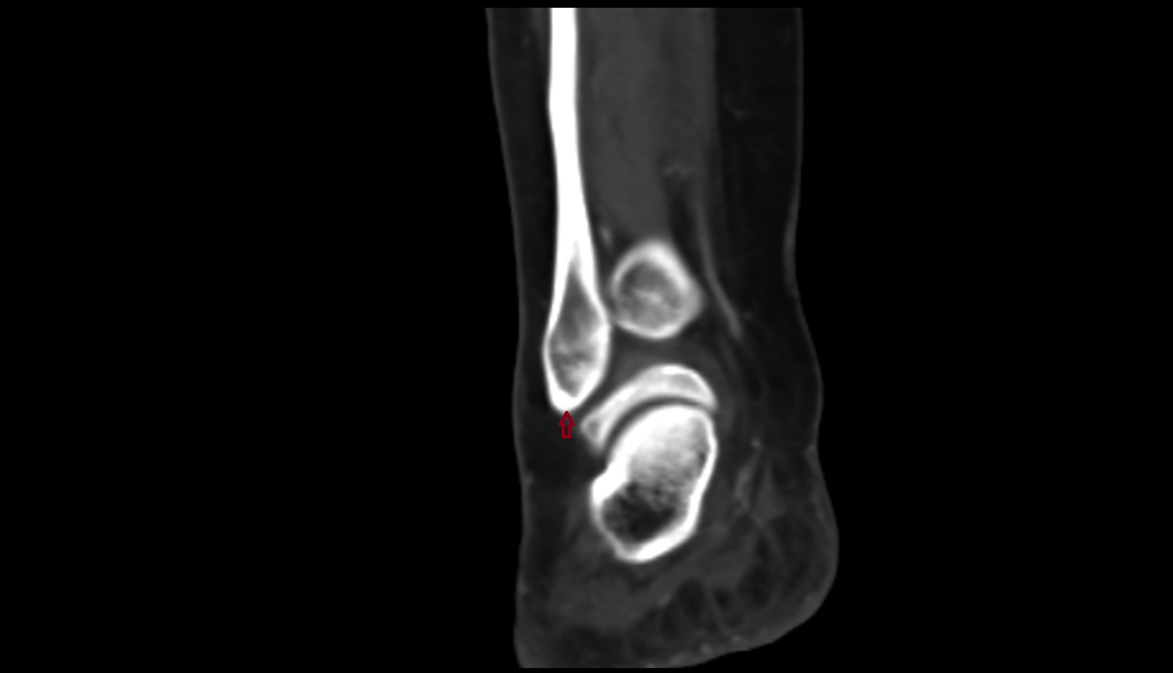 Apex of lateral malleolus ct
