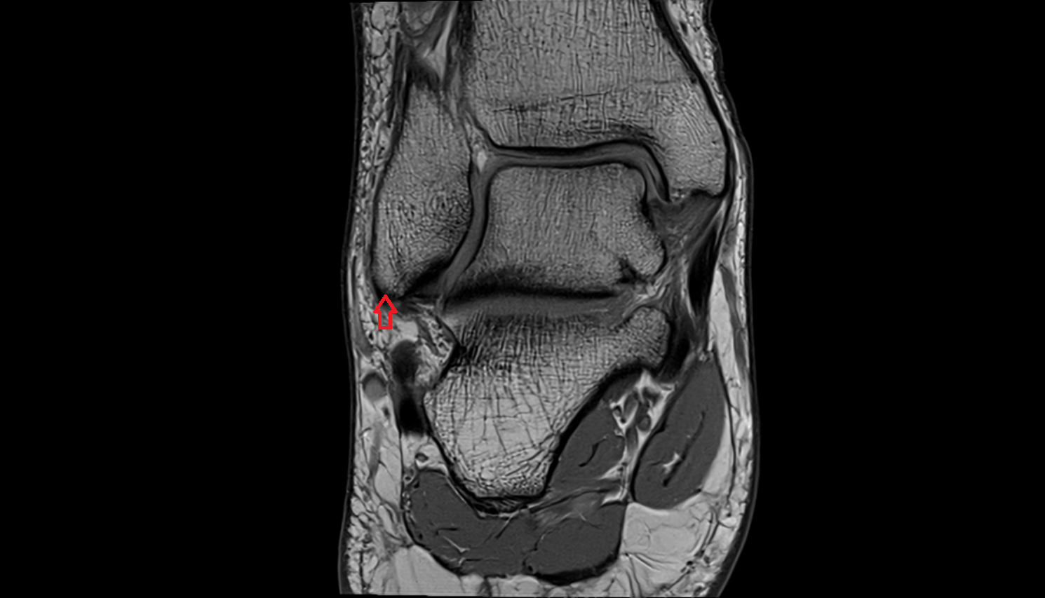 Apex of lateral malleolus  mri  anatomy labelled image-img-00000-00000