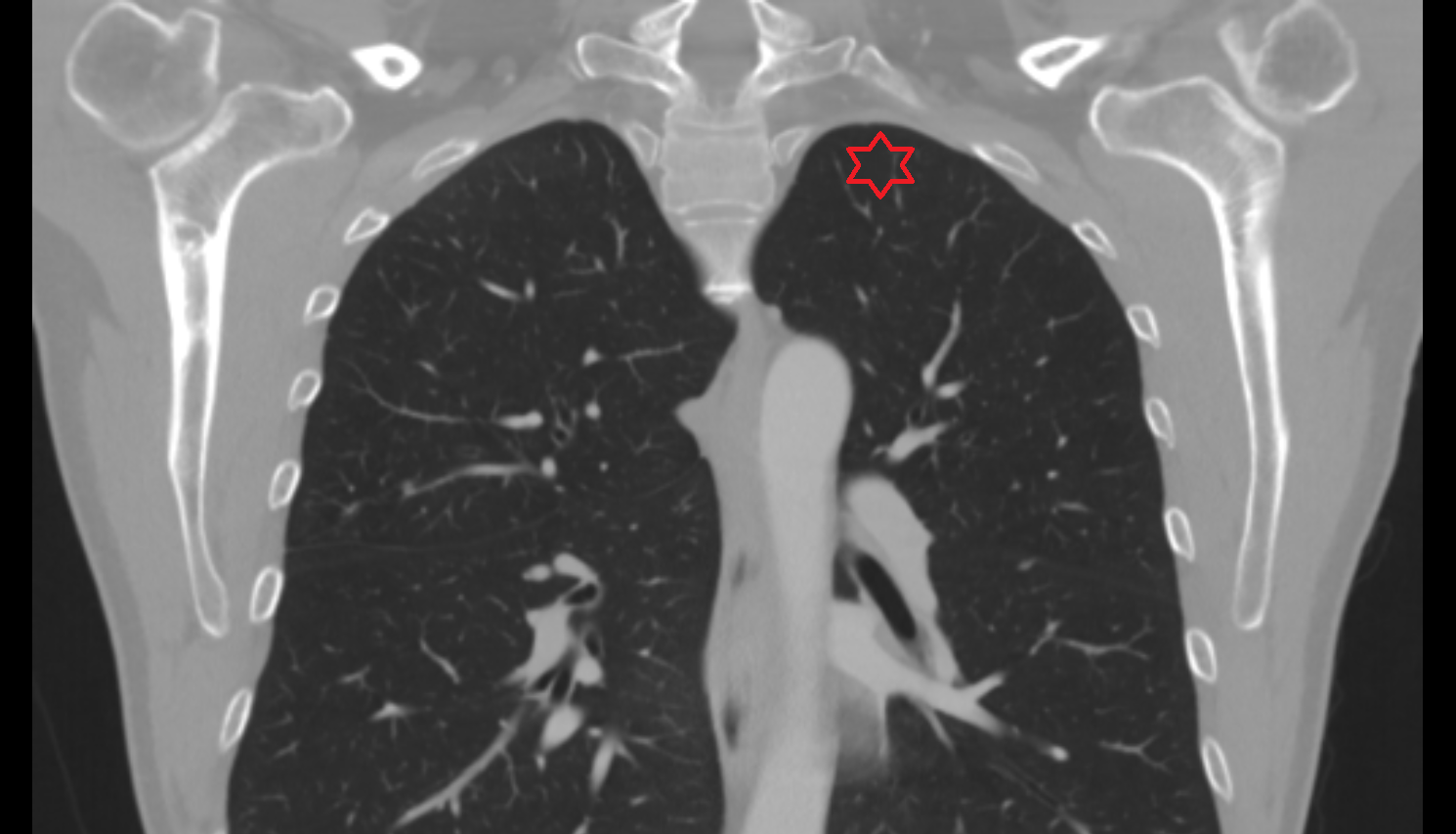 Apex of left lung CT anatomy image -img-00000-00000
