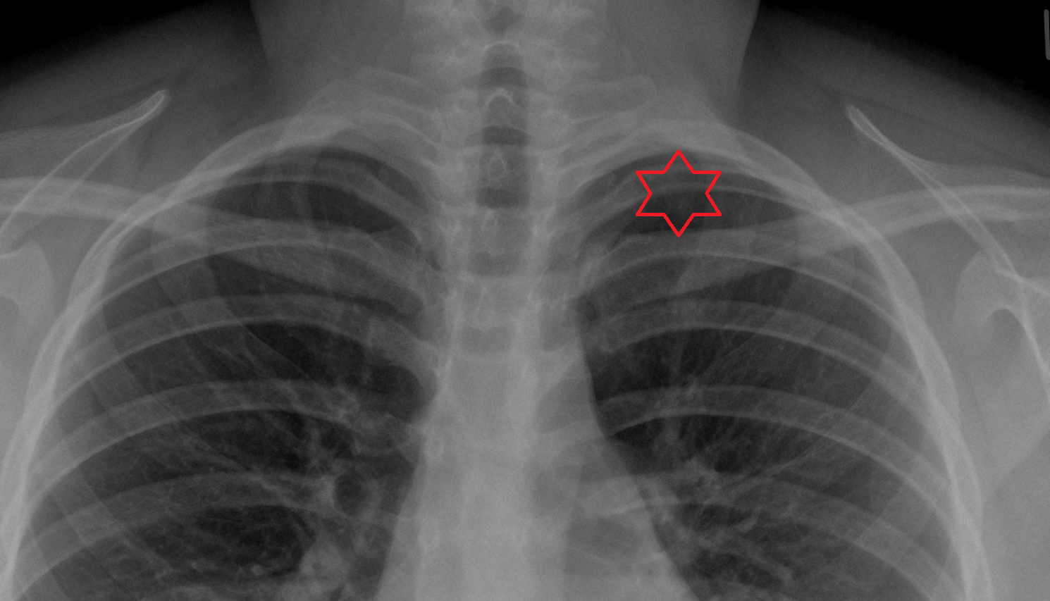 Apex of left lung X RAY anatomy image -img-00000-00000