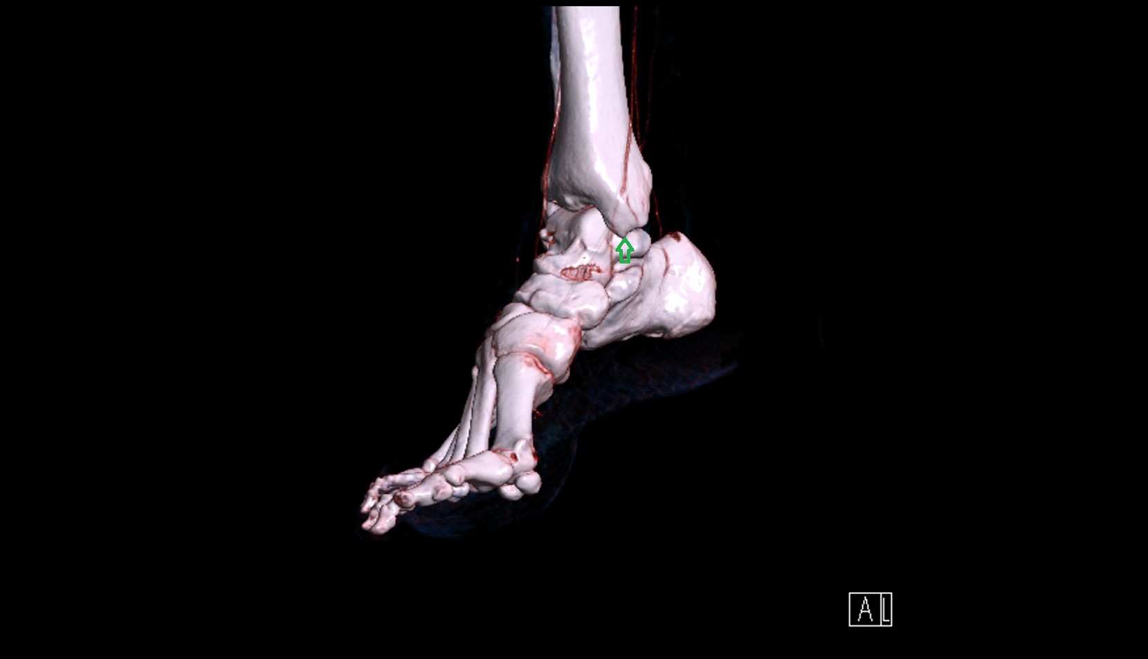 Apex of medial malleolus 3d