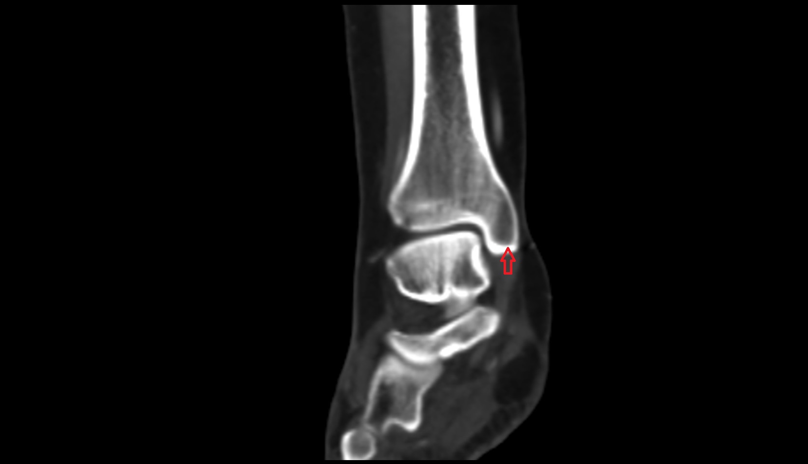 Apex of medial malleolus ct