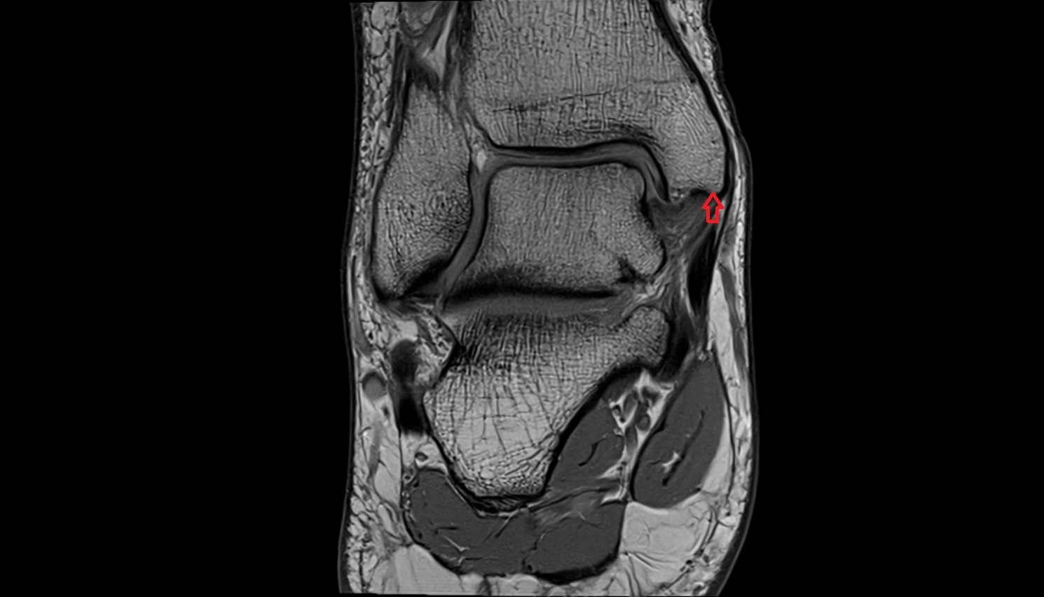 Apex of medial malleolus  mri  anatomy labelled image-img-00000-00000