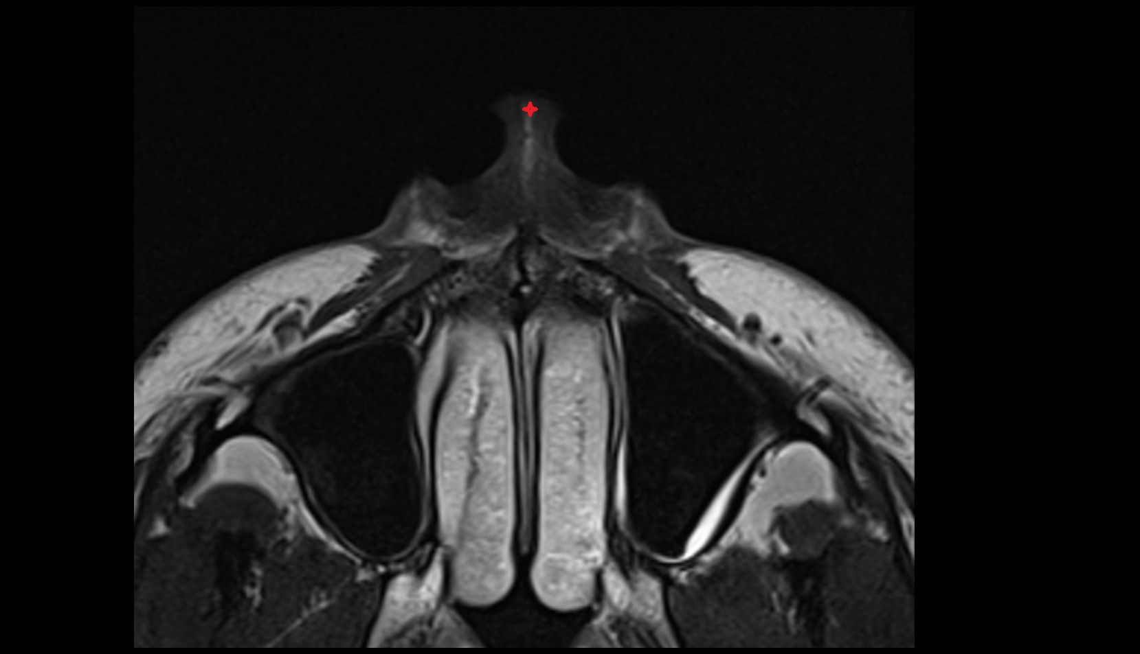 Apex of nose axial mri