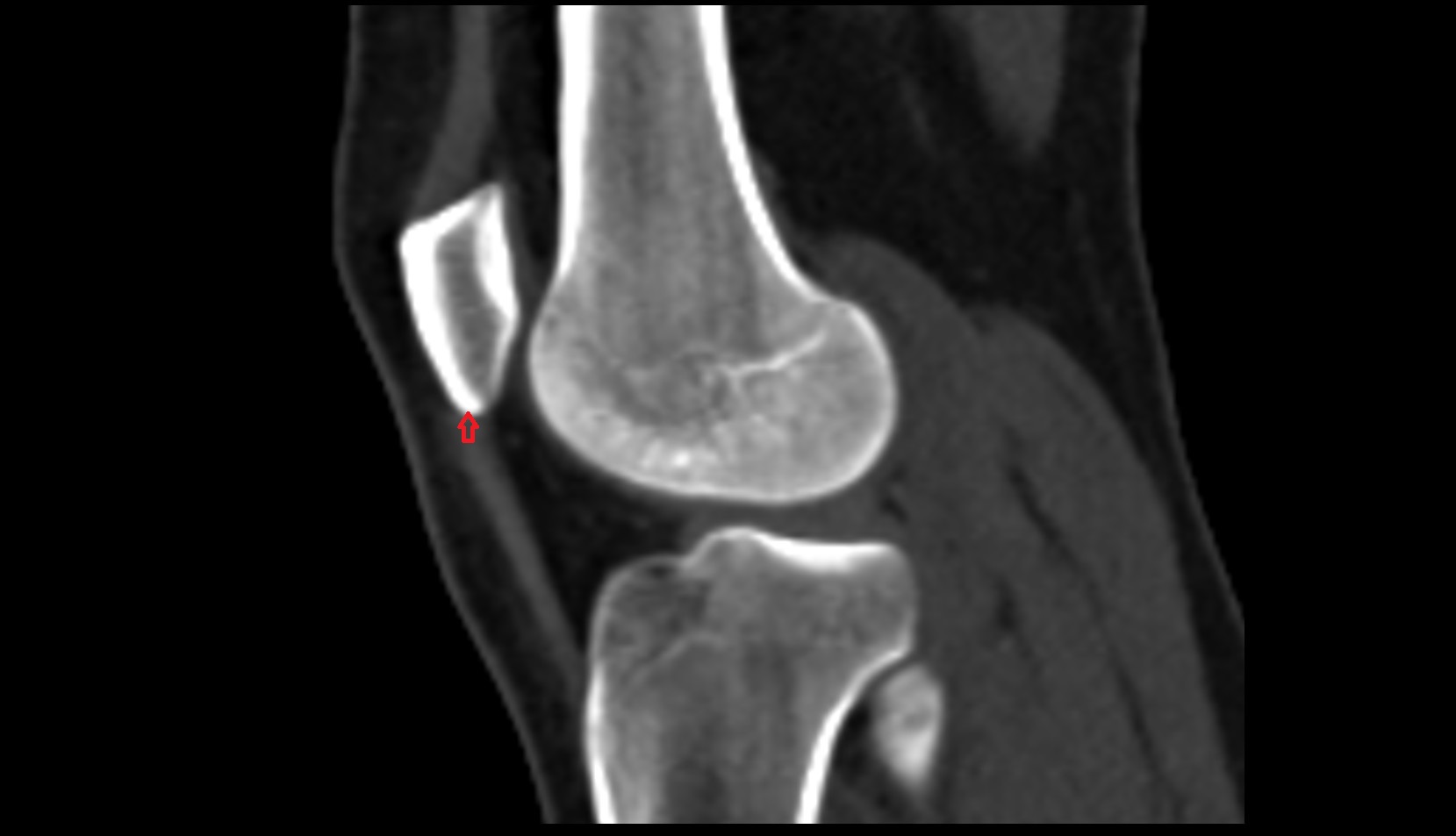 Apex of patella ct sag  image