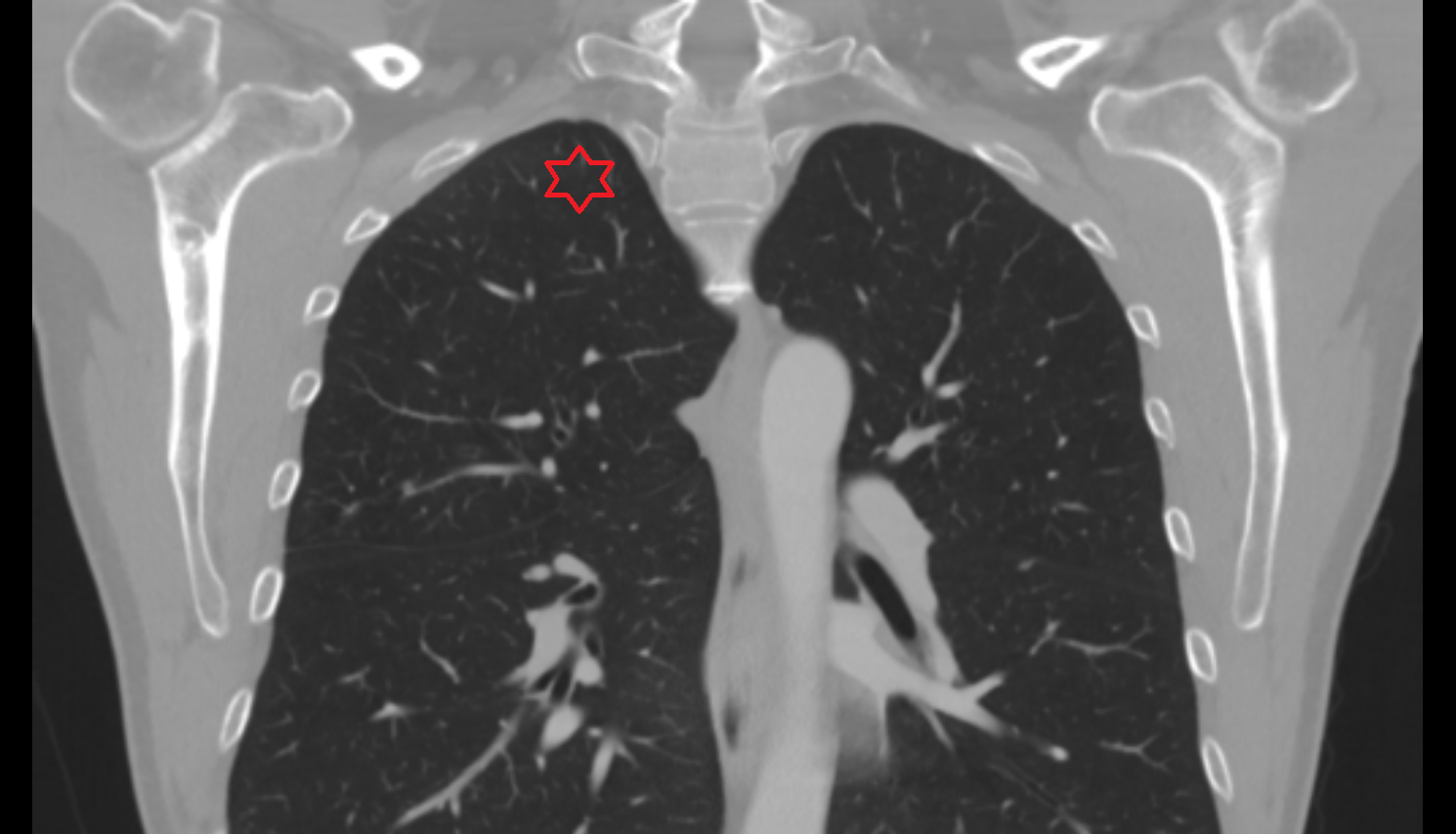 Apex of right lung CT anatomy image -img-00000-00000