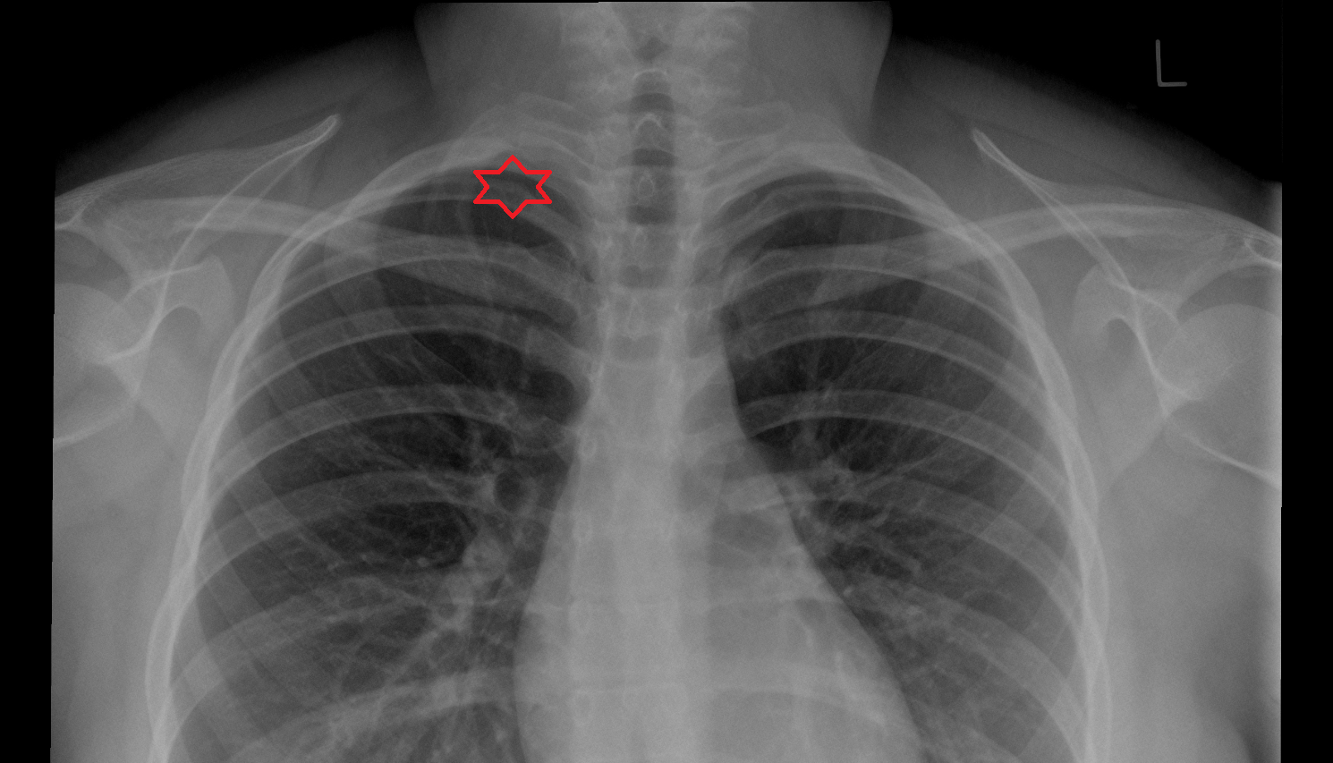 Apex of right lung X ray anatomy image -img-00000-00000