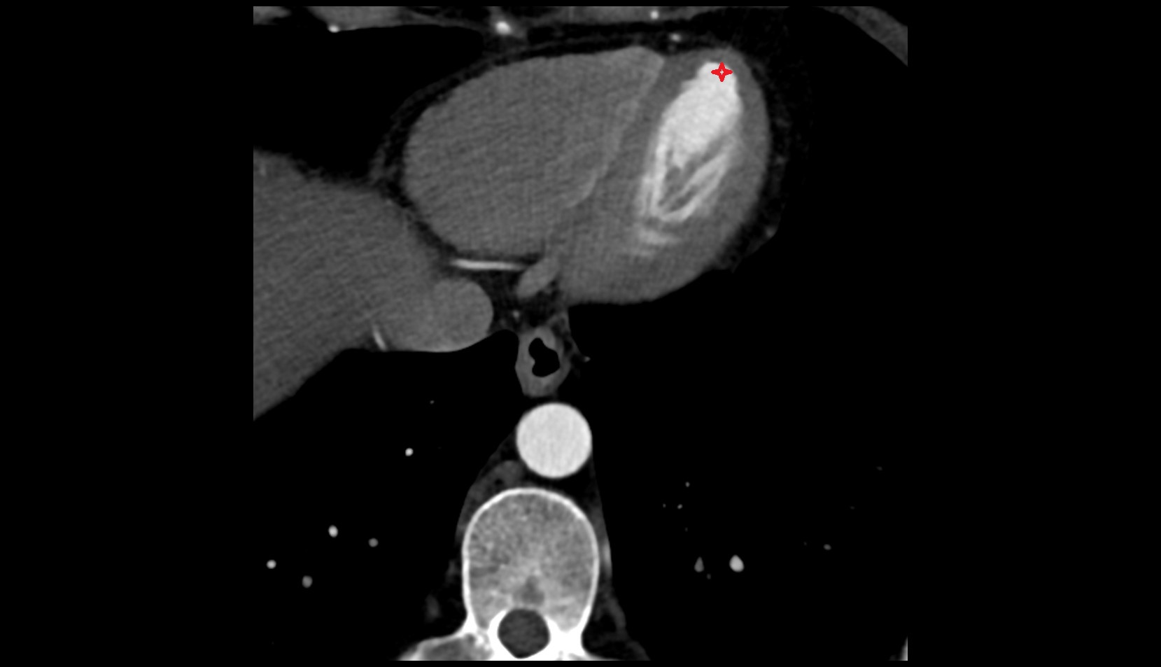Apex of the heart CT axial image