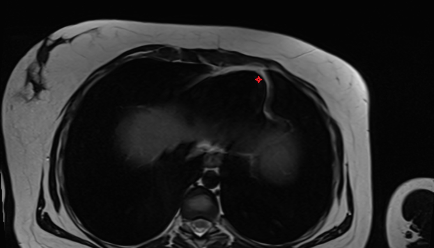 Apex of the heart  MRI axial  image anatomy  image -img-00000-00000