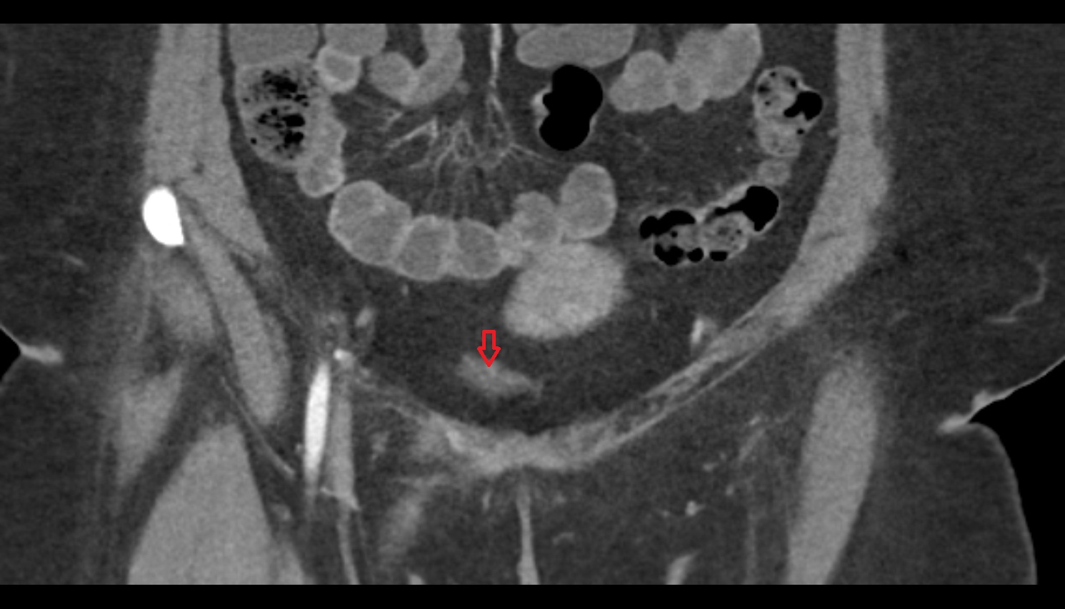 Apex of urinary bladder  ct coronal  anatomy  image-img-00000-00000