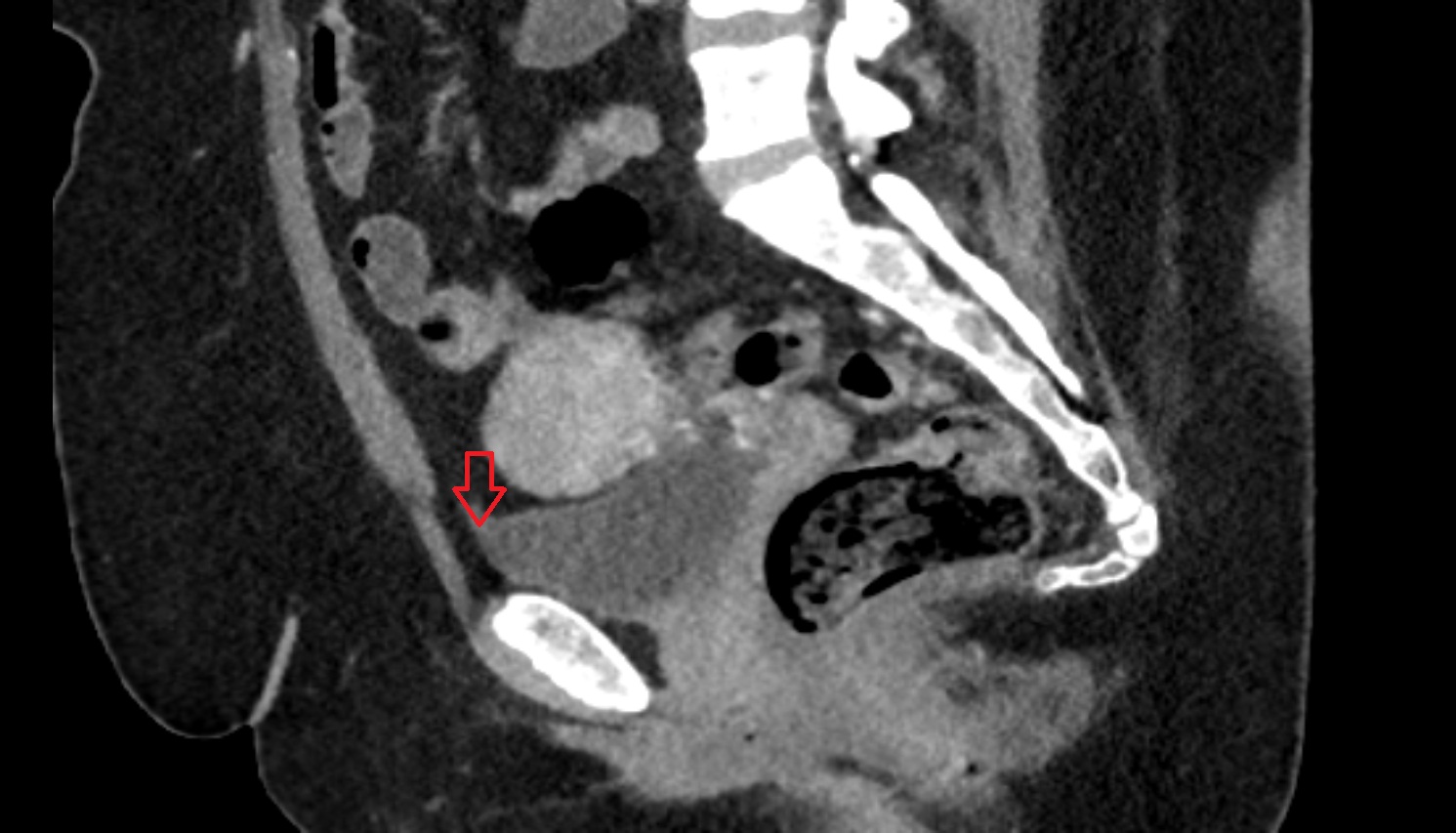Apex of urinary bladder  ct  sag  anatomy  image-img-00000-00000