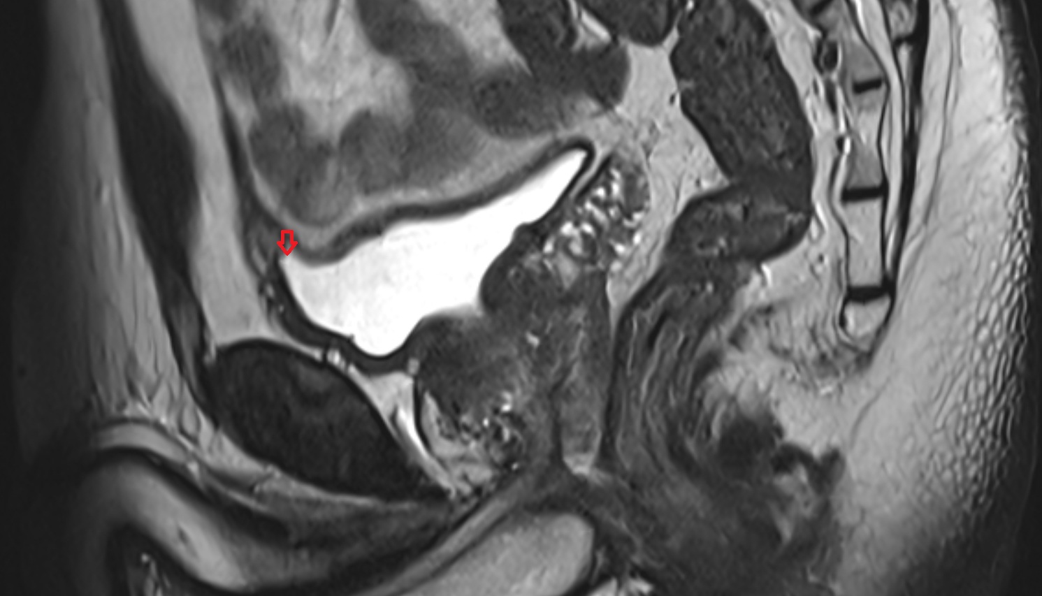 Apex of urinary bladder  mri  sag  anatomy  image-img-00000-00000