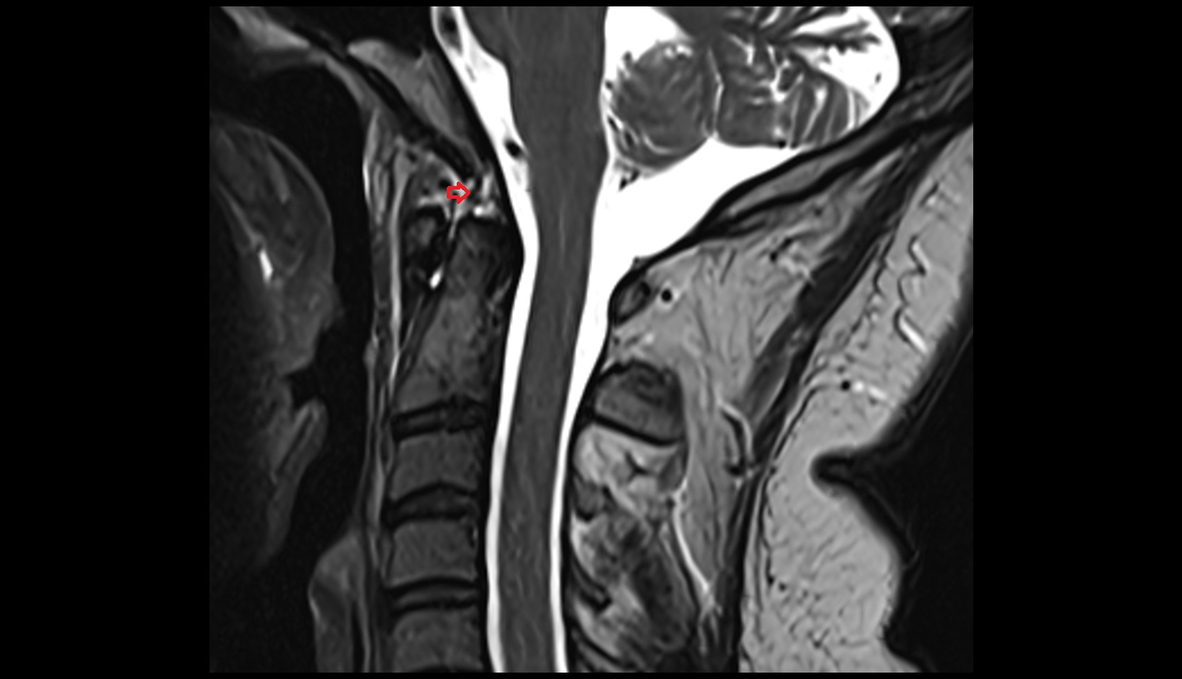Apical ligament of dens sagittal mri image