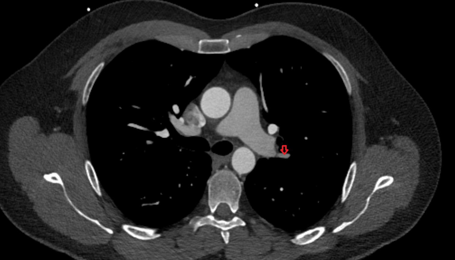 Apical segmental artery of left lung  anatomy ct axial  image -img-00000-00000_00001