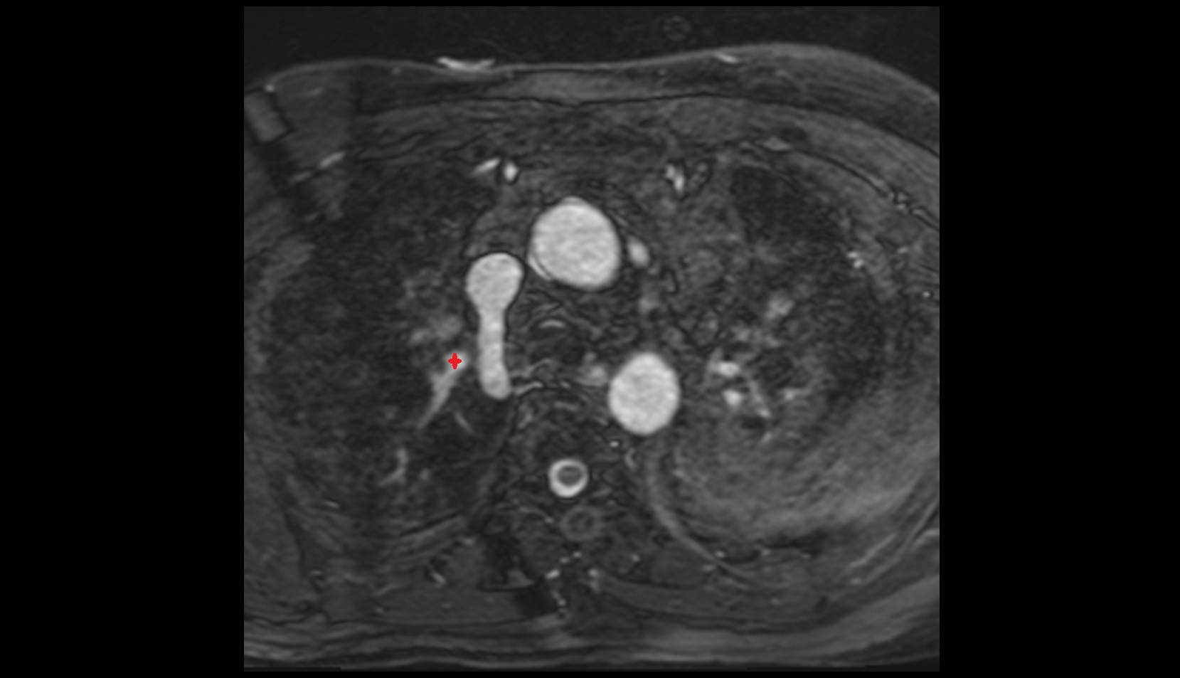 Apical segmental artery of left lung  mri axial image