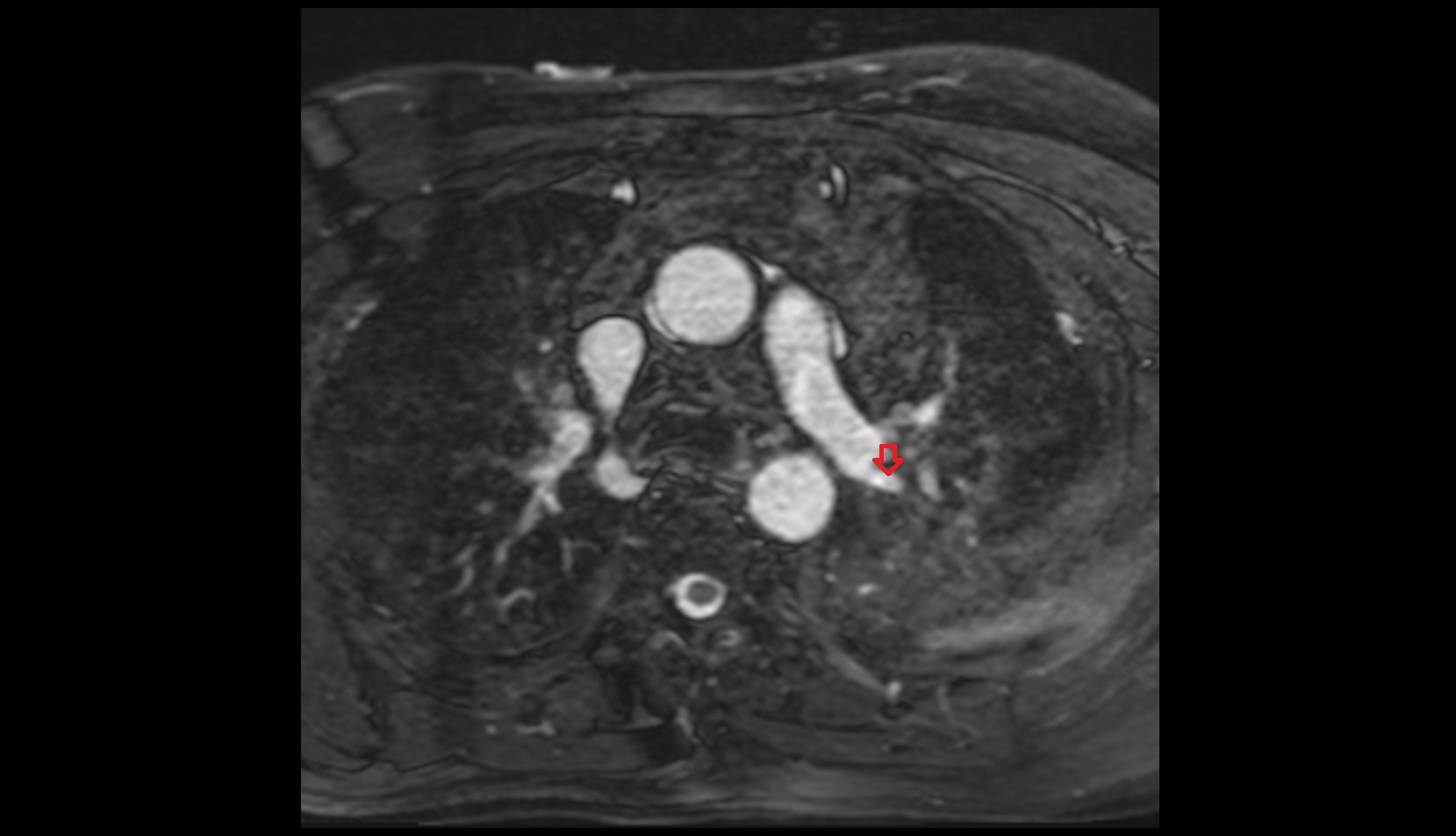 Apical segmental artery of left lung mri image